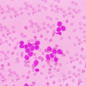 Acute lymphocytic leukaemia