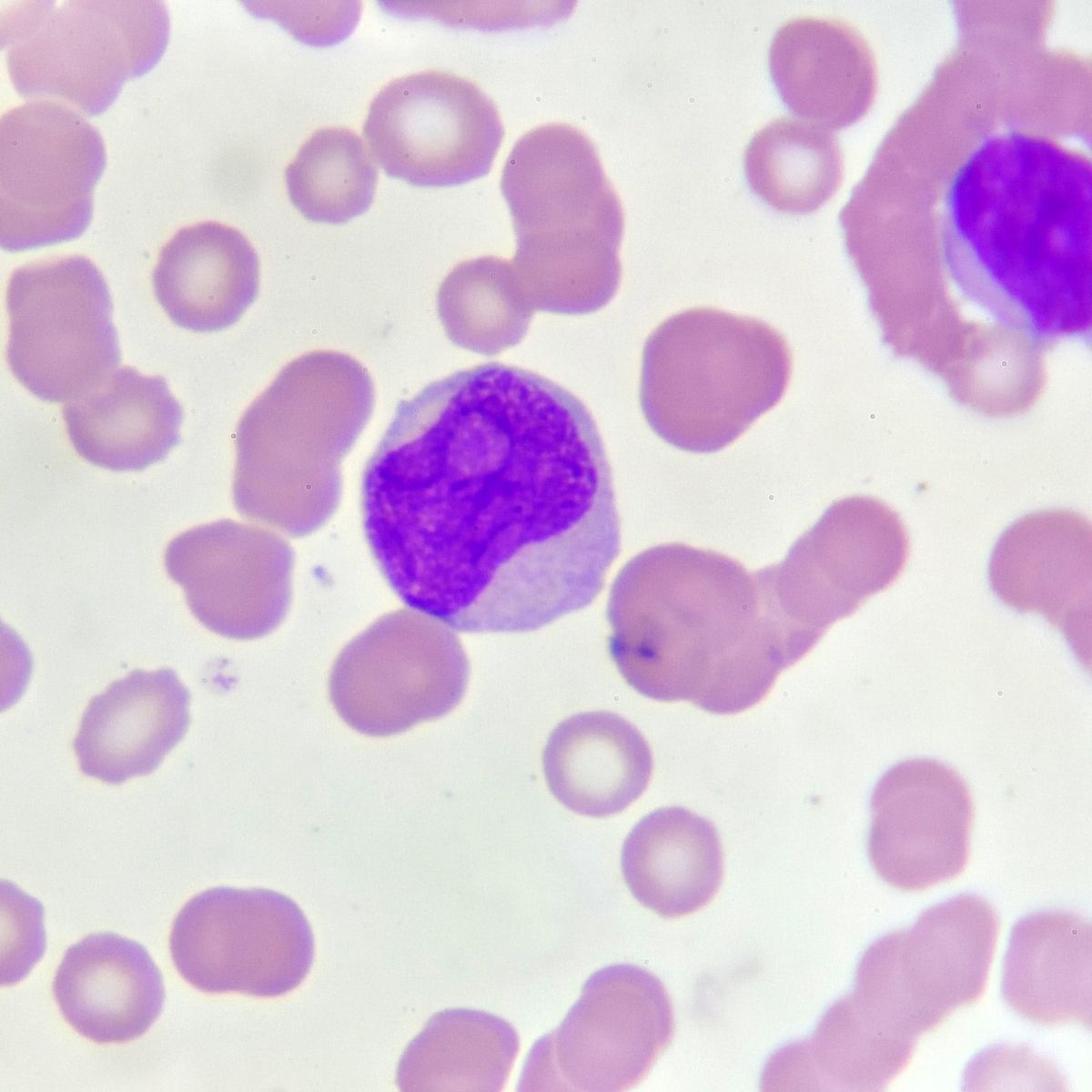 Acute myeloid leukemia