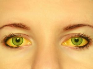 All about jaundice