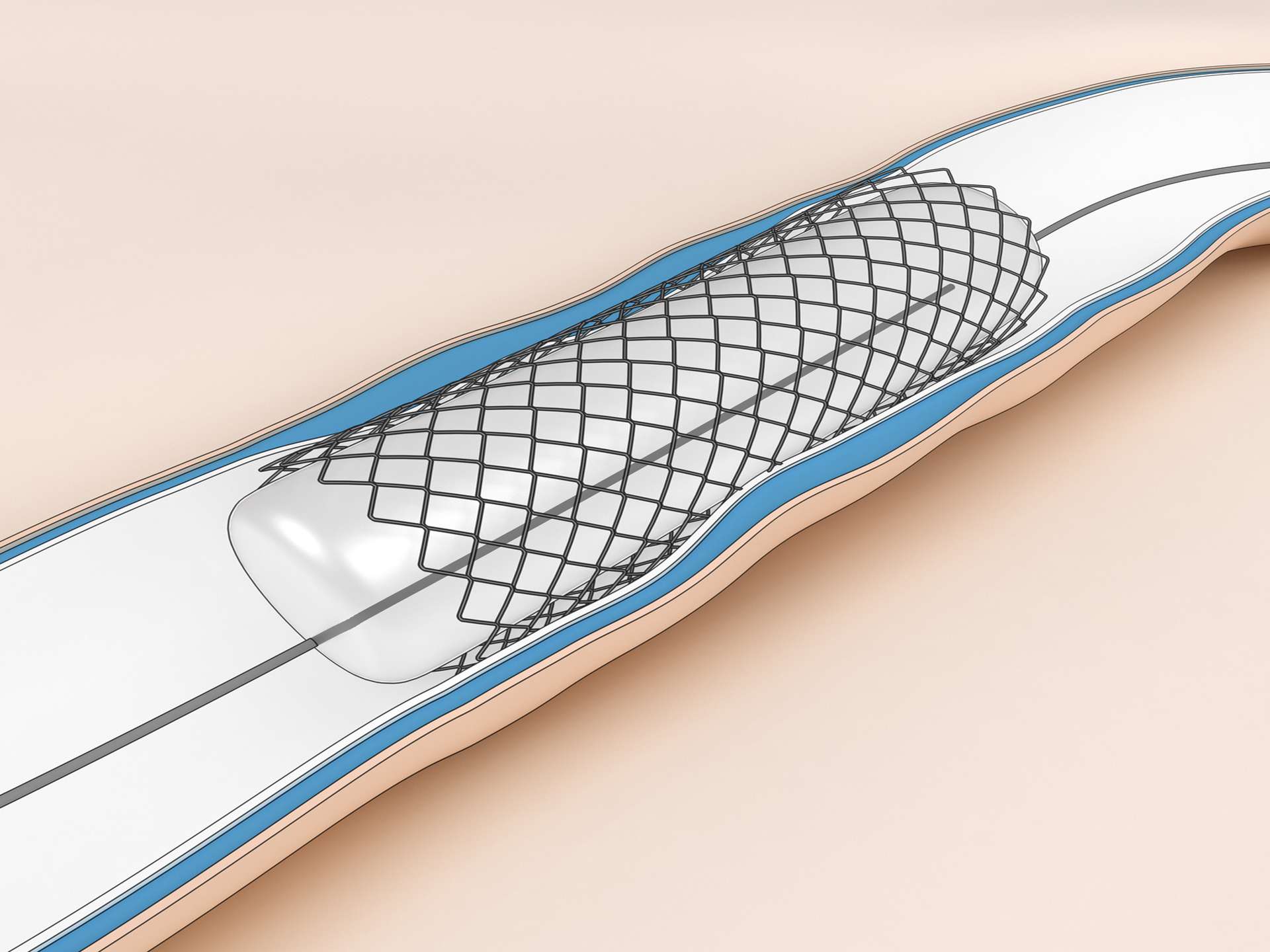 All you need to know about angioplasty!