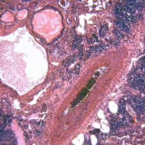 Amoebic lung abscess