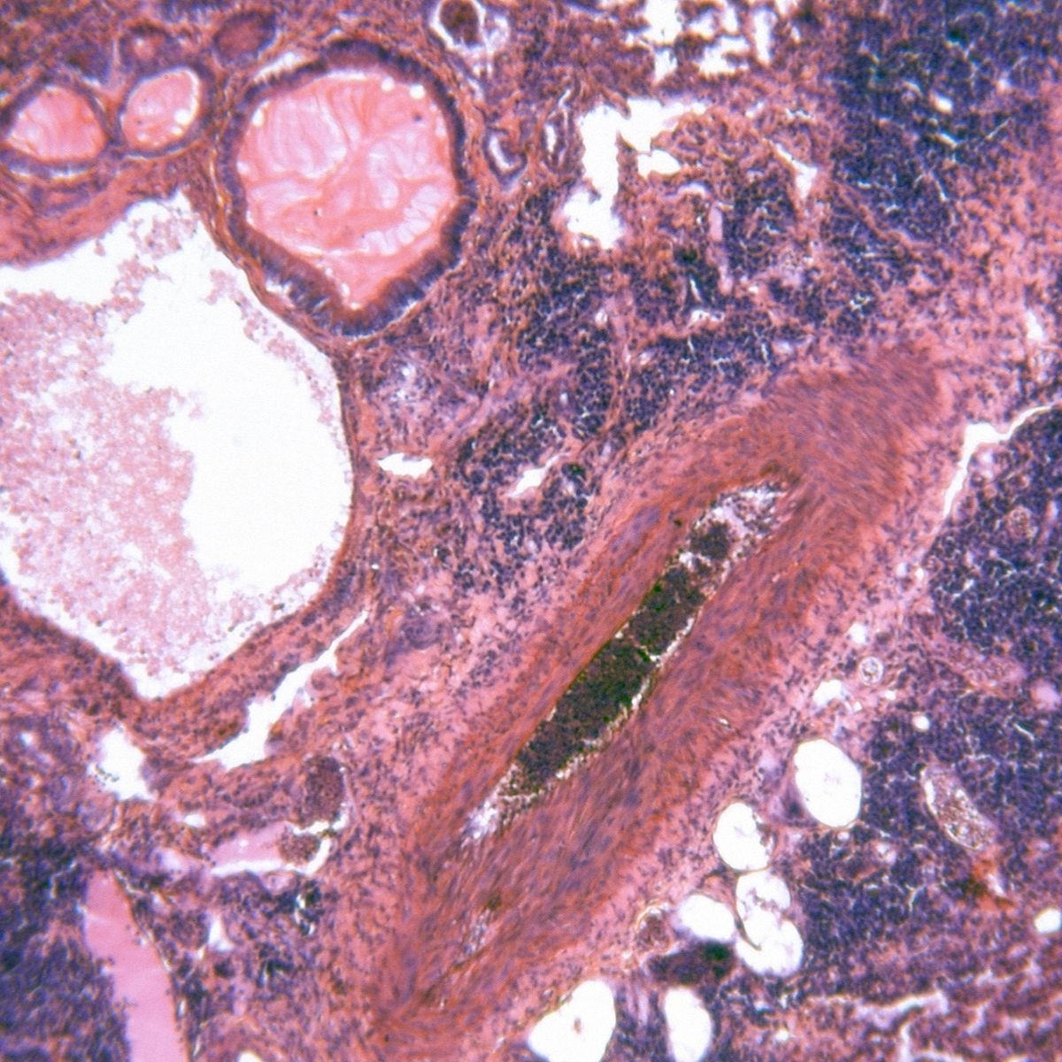 Amoebic lung abscess