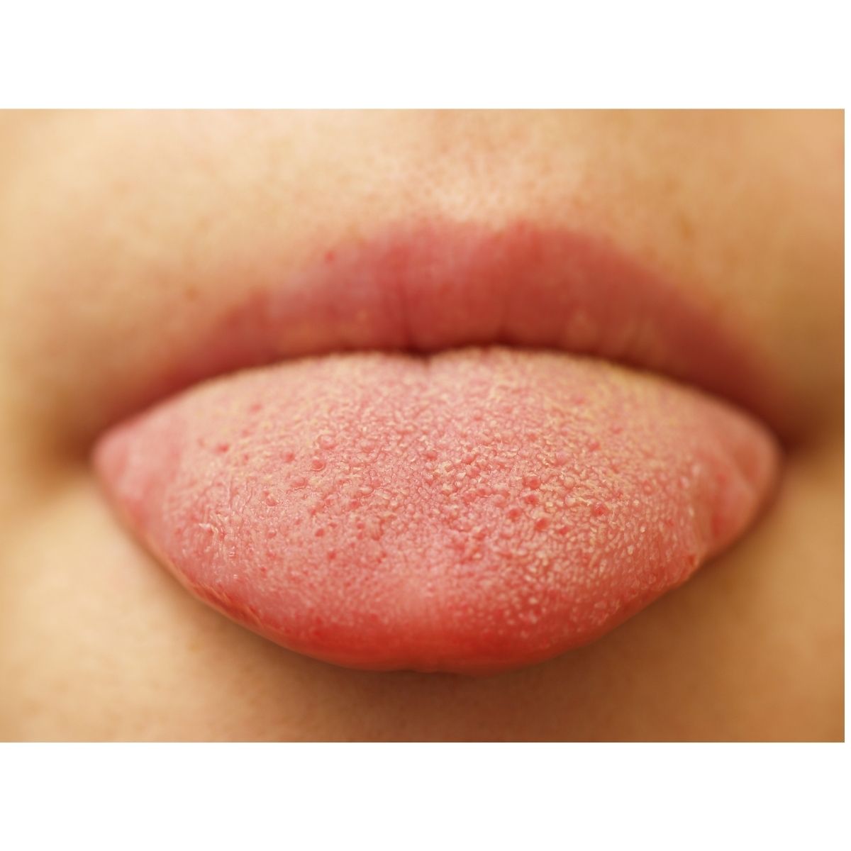 Ankyloglossia (Tongue tie)