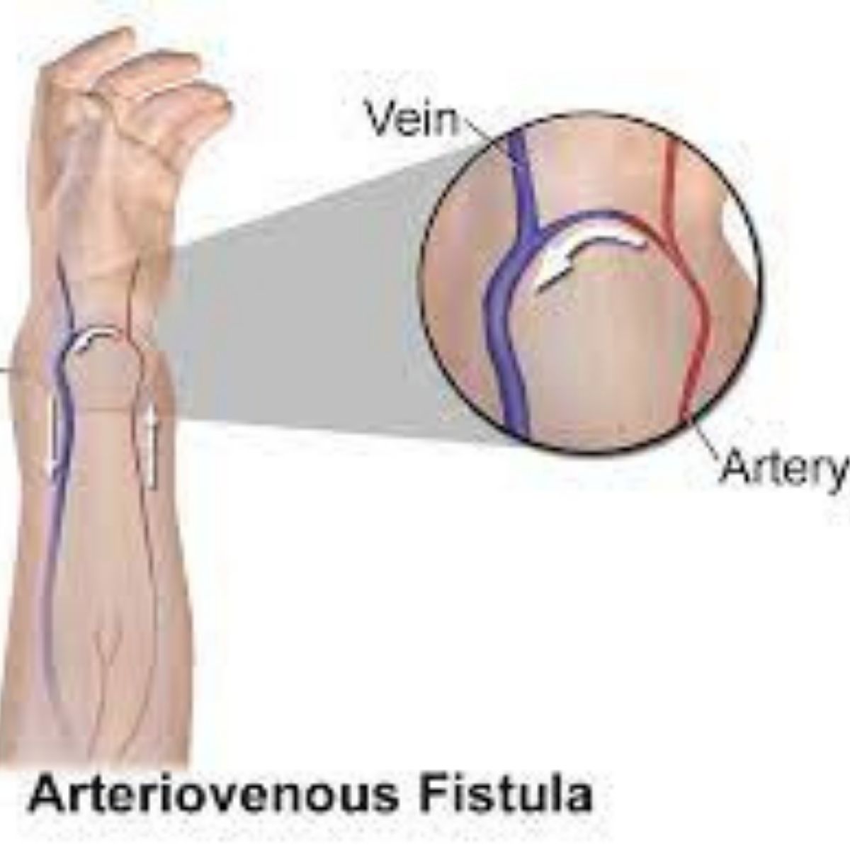 Arteriovenous fistula