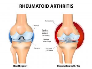 Arthritis – Symptoms and preventive care