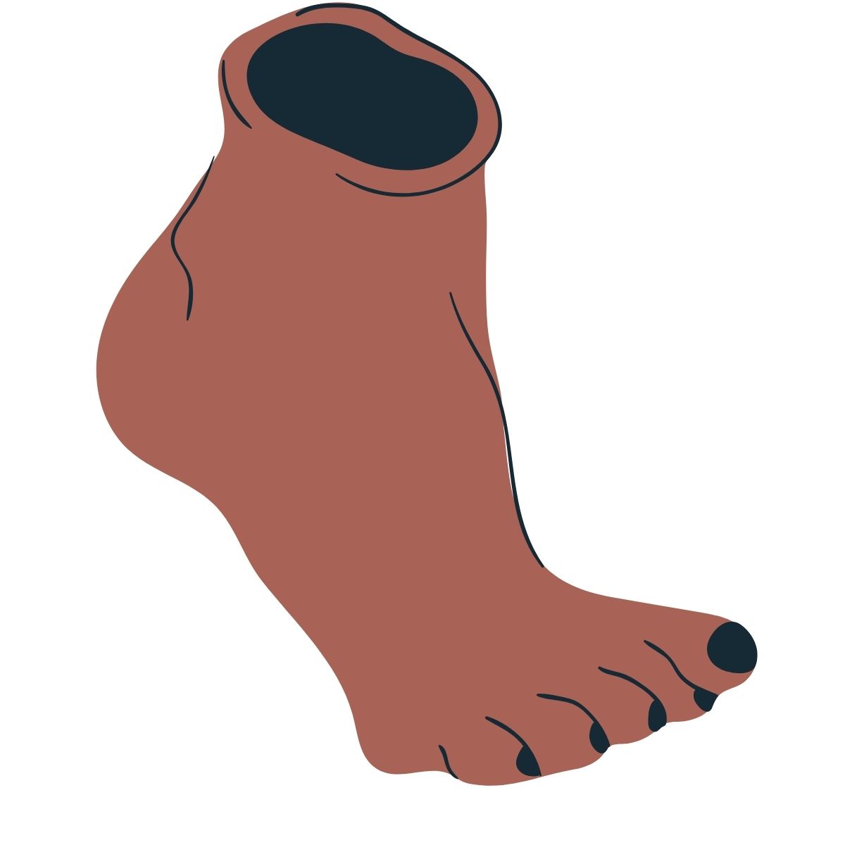Athlete’s foot (Tinea pedis, tinea pedum, moccasin foot, ringworm of the foot)