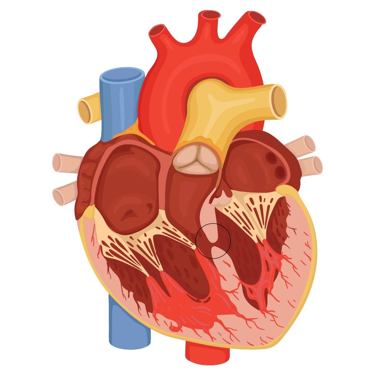 Atrial septal defect