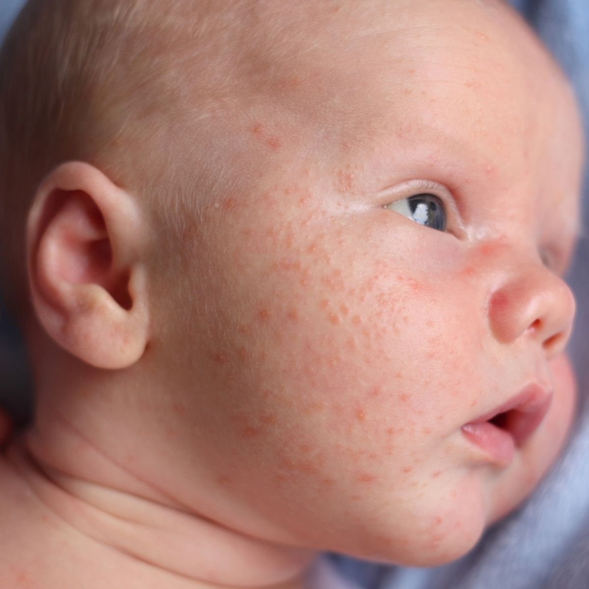 Baby acne