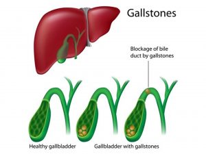 Bile block – Understanding gallbladder problems