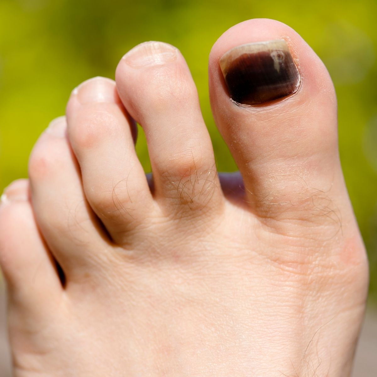 Black toenails