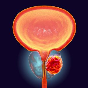 Bladder cancer