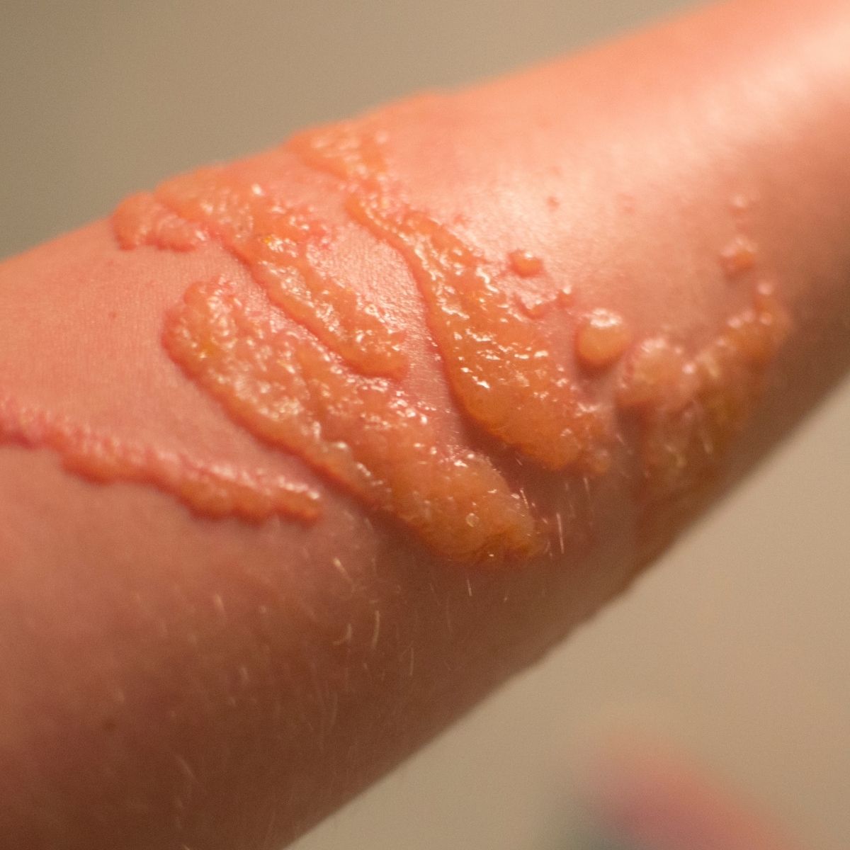 Bullous pemphigoid