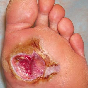 Buruli ulcer