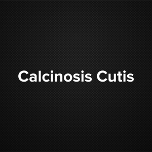 Calcinosis cutis