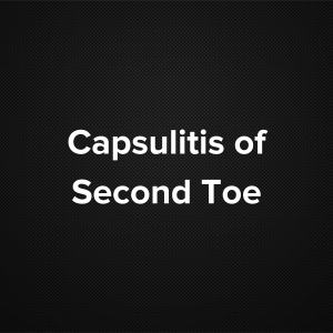 Capsulitis of second toe