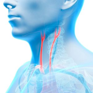 Carotid artery disease