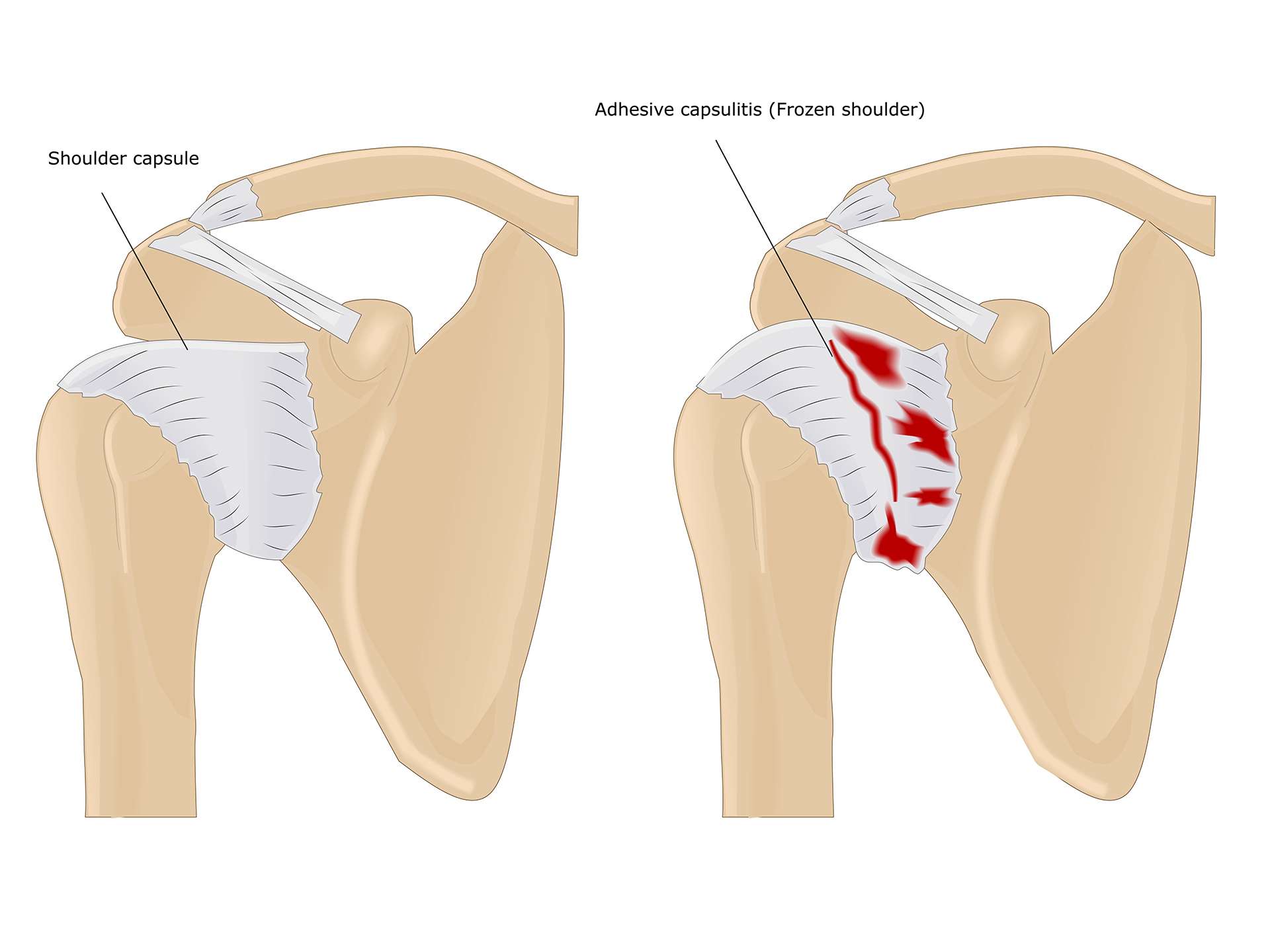 Chilled to the bone – Understanding frozen shoulder