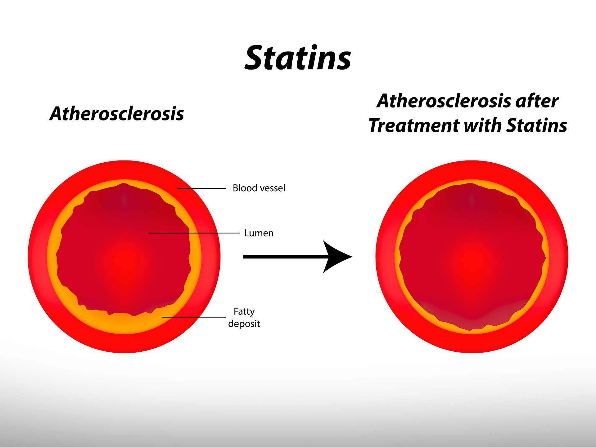 Cholesterol lowering bullets : Statins