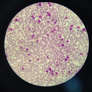 Chronic myelogenous leukemia