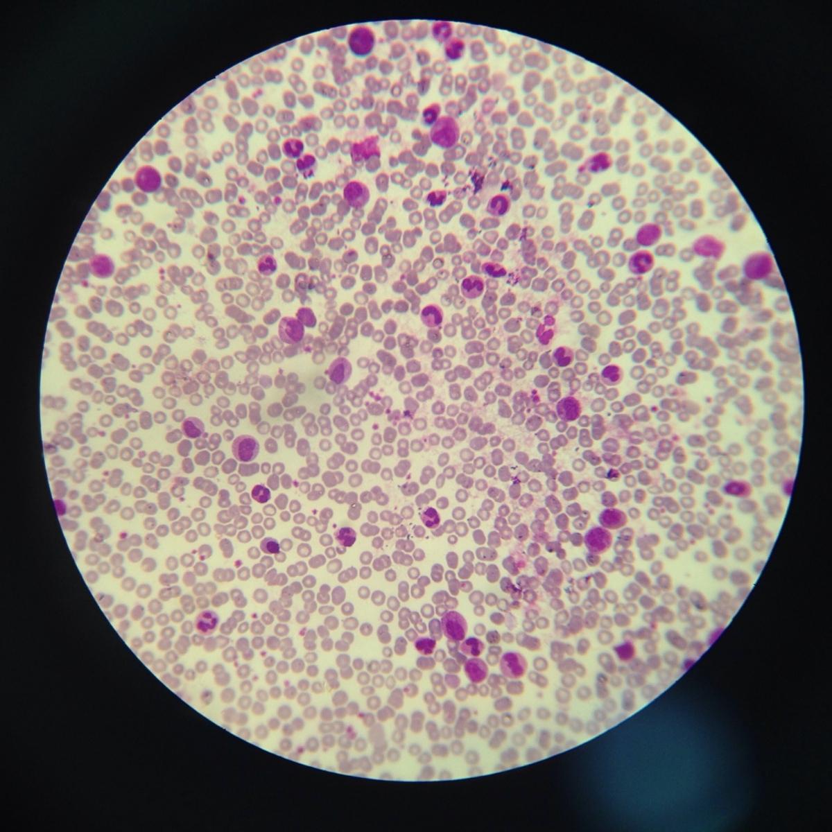 Chronic myelogenous leukemia