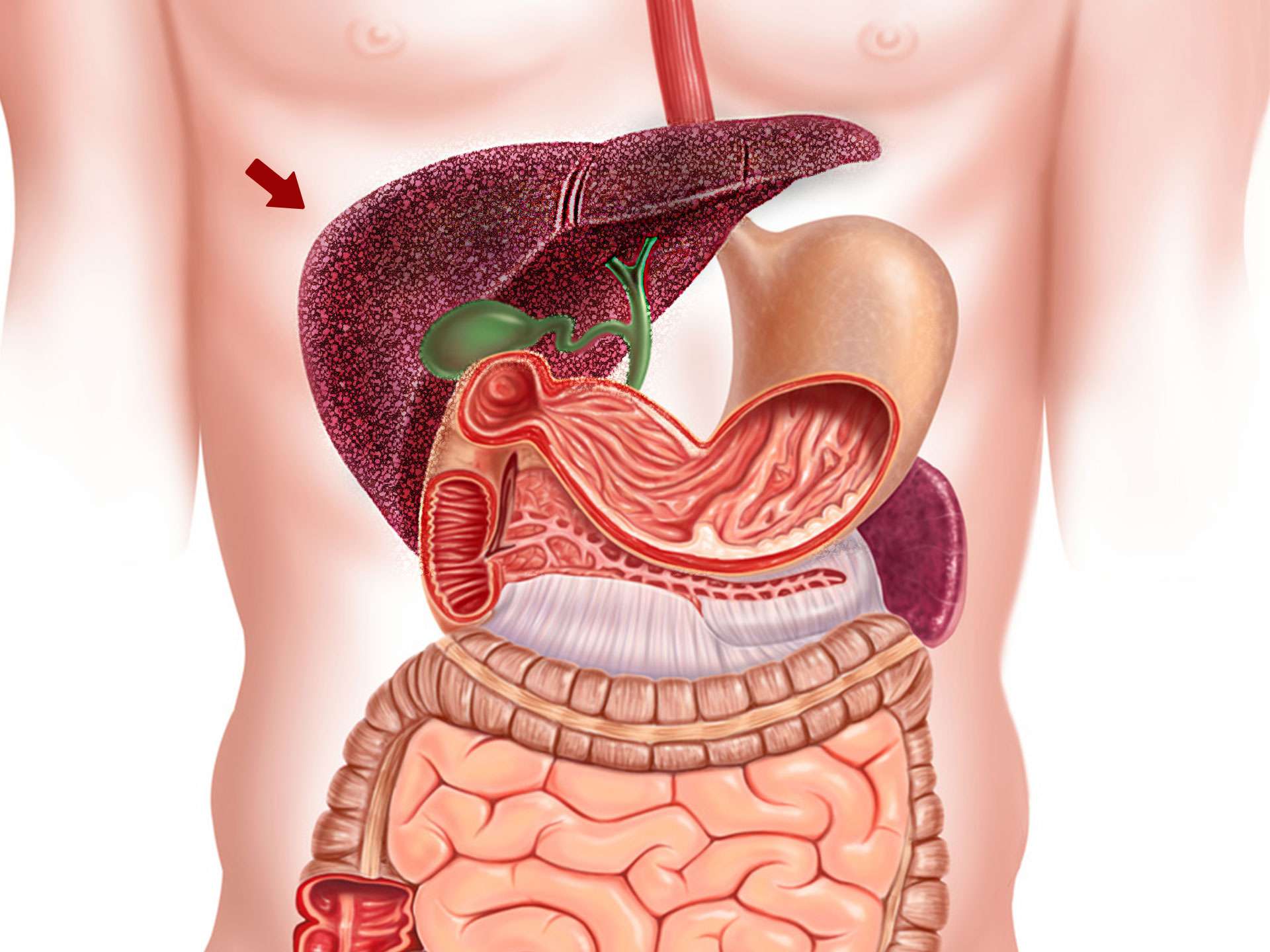 Cirrhosis of the liver – A common yet preventable liver condition