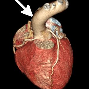 Coarctation of the aorta