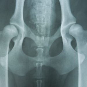 Congenital dysplasia of hip