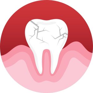 Cracked tooth syndrome