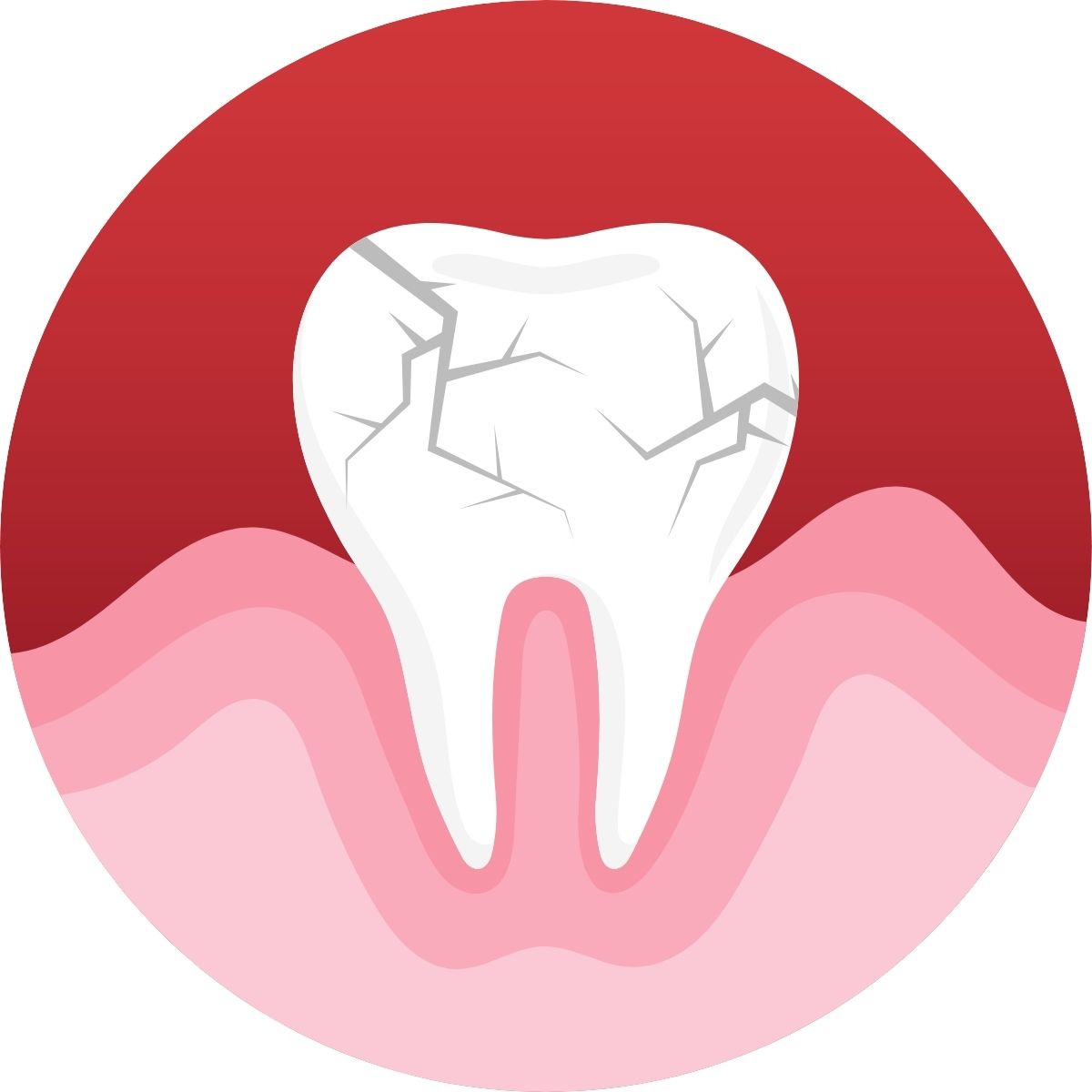 Cracked tooth syndrome