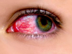 Dealing with eye problems when you are diabetic – Diabetic retinopathy