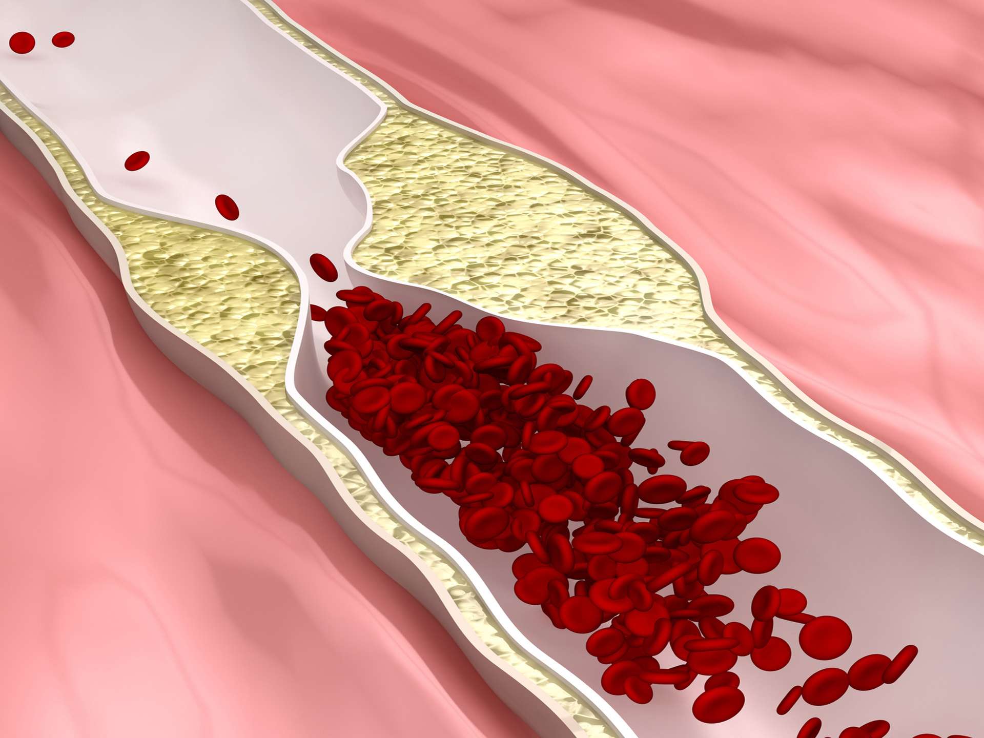 Deep inside your heart – Atherosclerosis