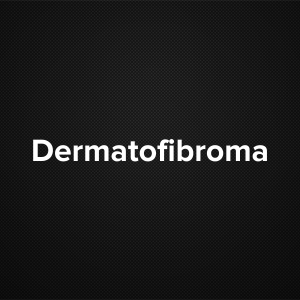 Dermatofibroma