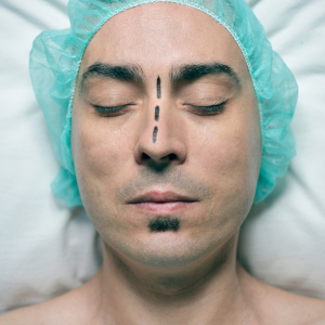 Deviated nasal septum (DNS)