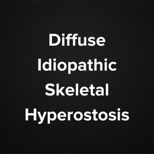 Diffuse Idiopathic Skeletal Hyperostosis ( Forestier’s disease, senile ankylosing spondylosis, and ankylosing hyperostosis)