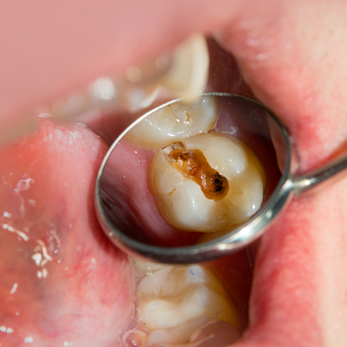 Dilaceration of teeth