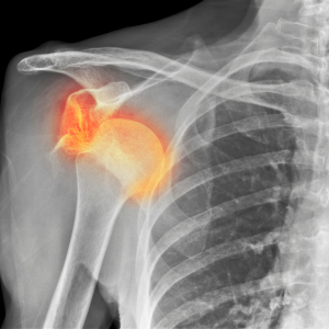 Dislocation of Shoulder