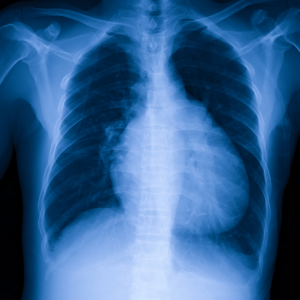 Enlarged Heart (Cardiomegaly)