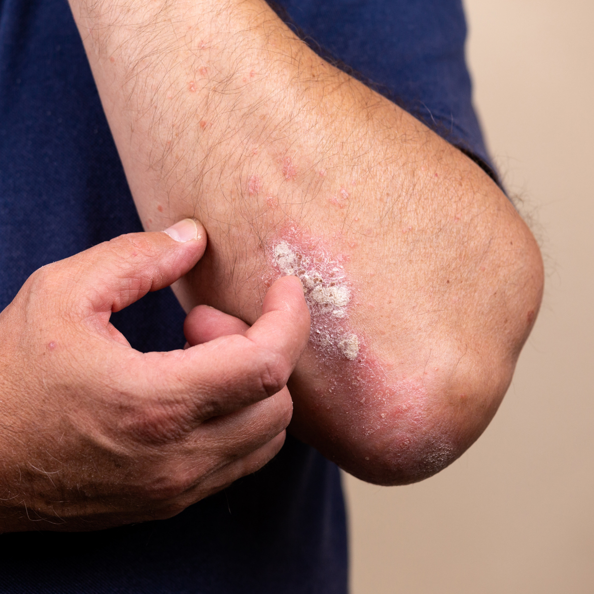 Exfoliative dermatitis