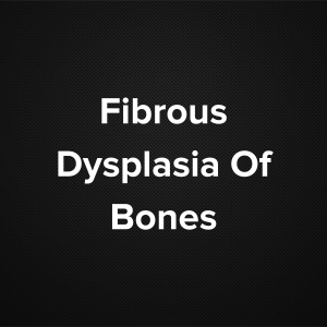 Fibrous Dysplasia of Bones