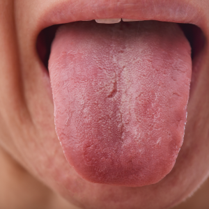 Fissured Tongue