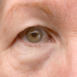 Floppy Eyelid Syndrome