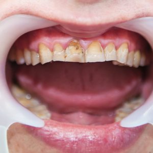 Fluorosis