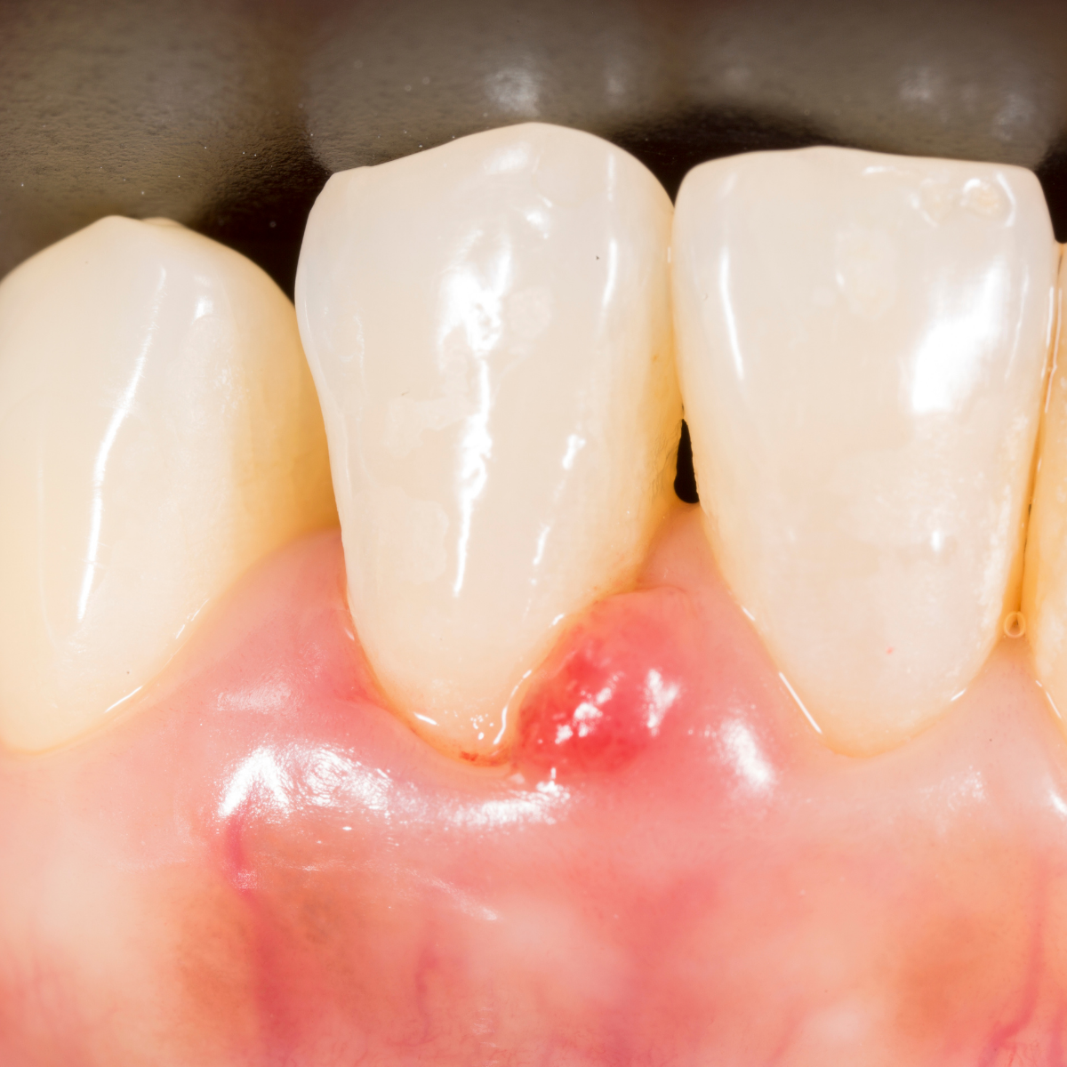 Gingival Enlargement