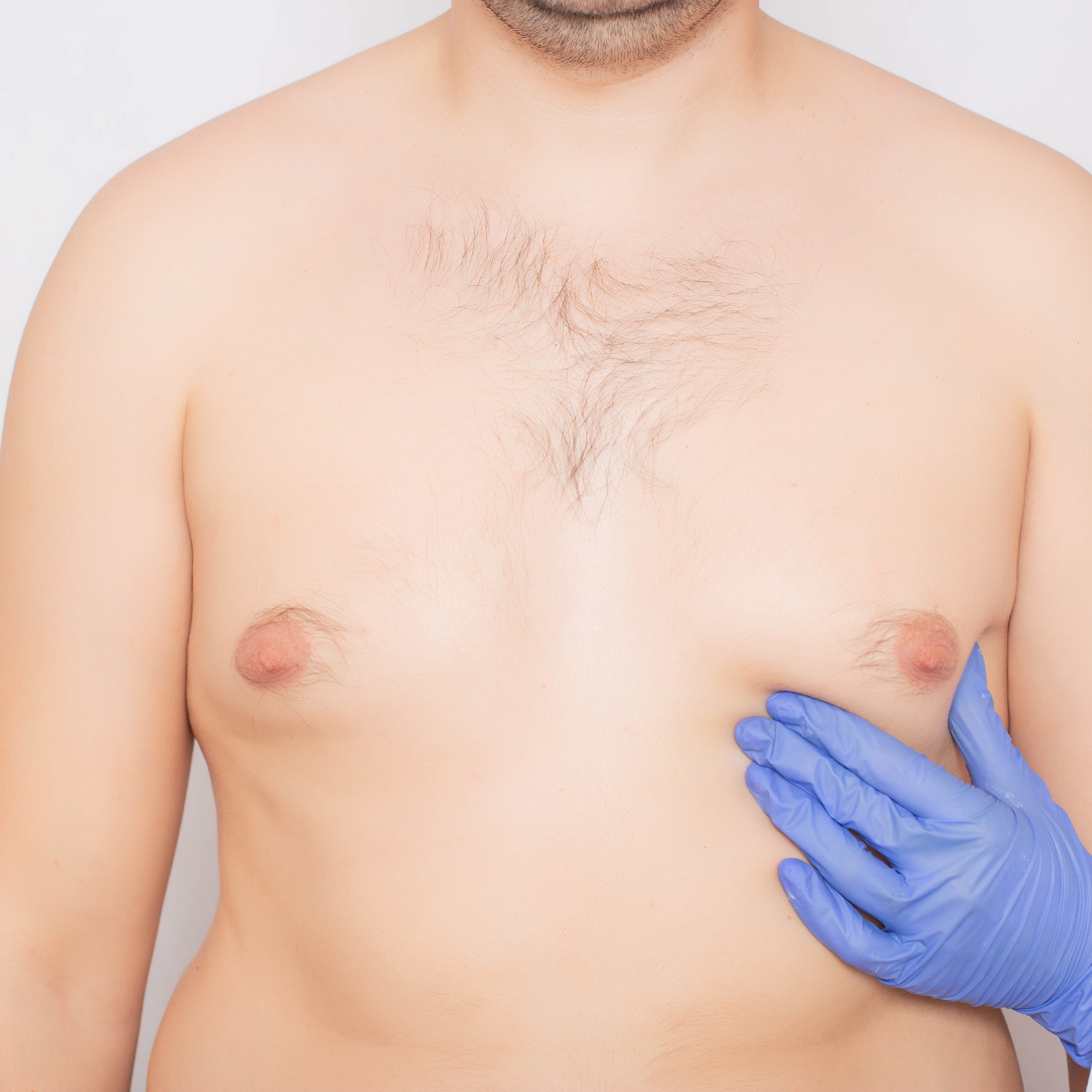 Gynecomastia