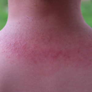 Heat Rash