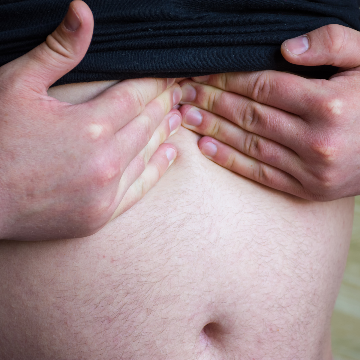 Hiatal Hernia (Hiatus hernia)