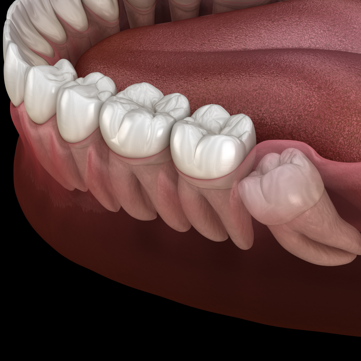 Impacted Wisdom Tooth