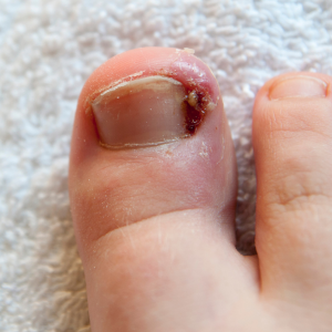 Ingrown Toenail
