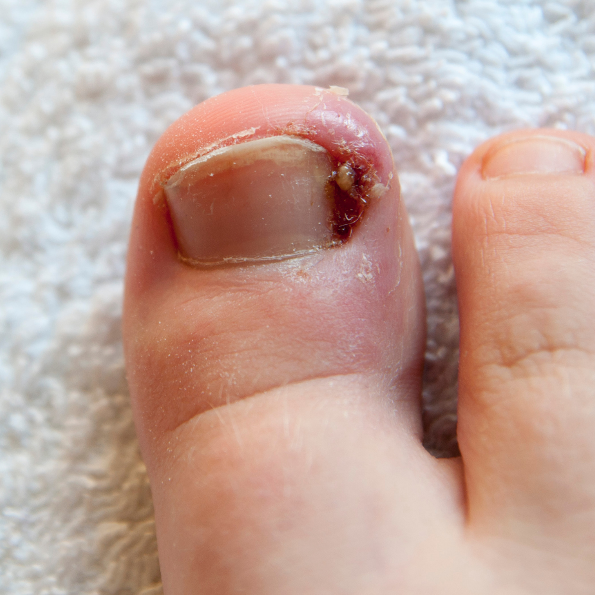 Ingrown Toenail