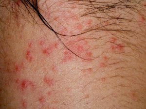 Is eczema contagious?